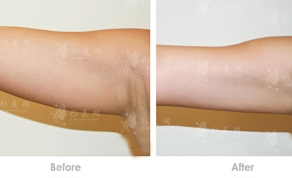 水動力溶脂減肥優(yōu)勢有哪些？看看這些科普吧！