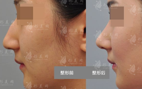 駝峰鼻矯正方法有哪些呢?效果怎么樣呢? 駝峰鼻矯正方法有哪些呢?效果怎么樣呢?