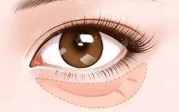 微創(chuàng)內(nèi)切去眼袋手術(shù)怎么樣？