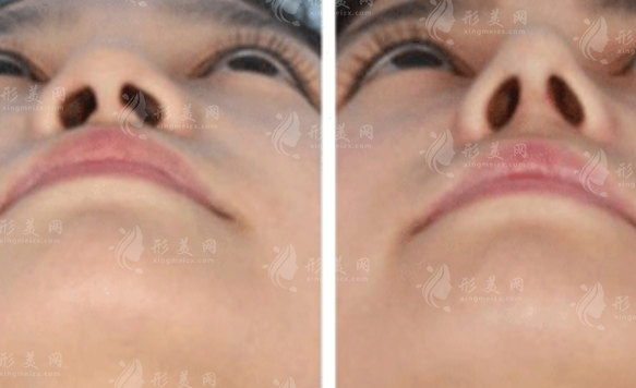 鼻翼縮小都有哪些后遺癥?該如何避免?