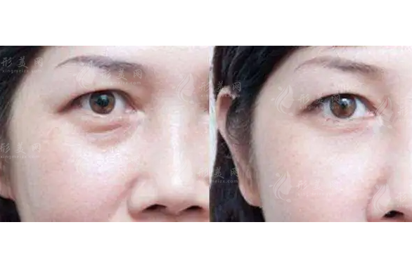 激光去眼袋效果好不好,做一次就有效果嗎? 激光去眼袋效果好不好,做一次就有效果嗎?