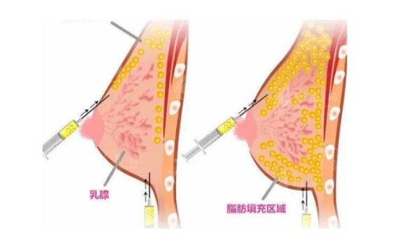 自體脂肪隆胸效果好不好，能保持多久時(shí)間？