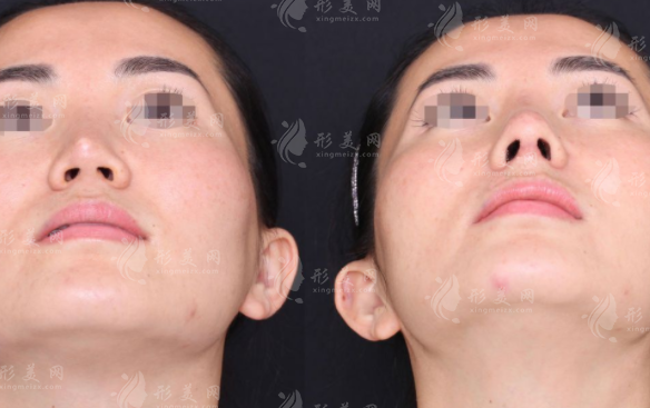 硅膠和膨體做鼻子哪個好，兩者選擇誰?