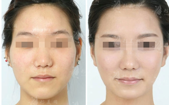 做自體脂肪豐太陽穴手術(shù)前應(yīng)該注意哪些事項? 做自體脂肪豐太陽穴手術(shù)前應(yīng)該注意哪些事項?