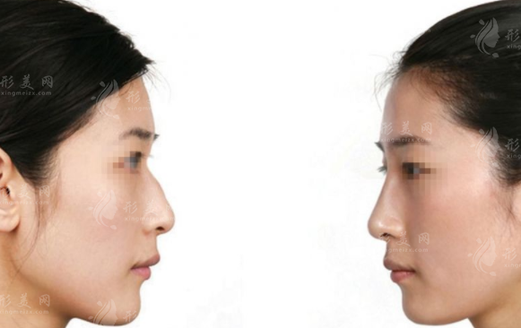 駝峰鼻整形術(shù)危險性高不高?有術(shù)后并發(fā)癥嗎? 駝峰鼻整形術(shù)危險性高不高?有術(shù)后并發(fā)癥嗎?