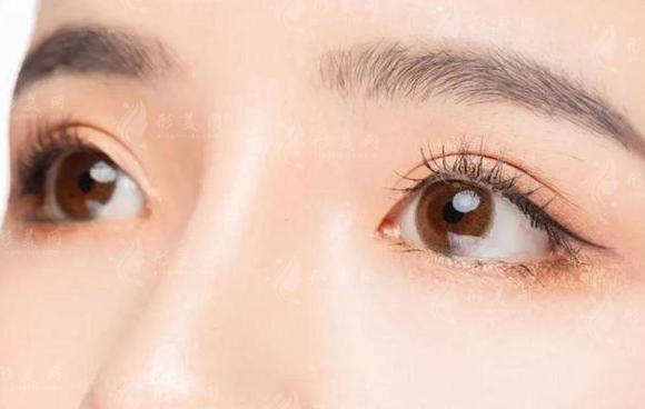 腫泡眼可以做雙眼皮手術(shù)嗎？需要注意什么？