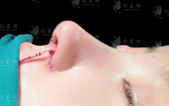 耳軟骨墊鼻梁維持多久時間？