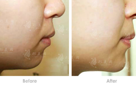 假體豐下巴出現(xiàn)哪些情況需要將假體取出？