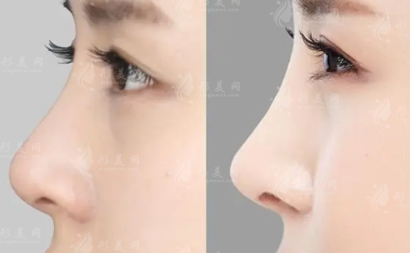 上海玫瑰整形醫(yī)院做鼻子怎么樣？實力醫(yī)生介紹、2024收費表