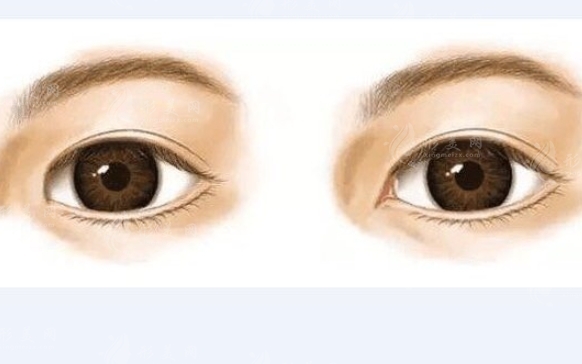 內(nèi)眥贅皮雙眼皮需要價錢是多少呢 影響的因素有哪些 內(nèi)眥贅皮雙眼皮需要價錢是多少呢 影響的因素有哪些