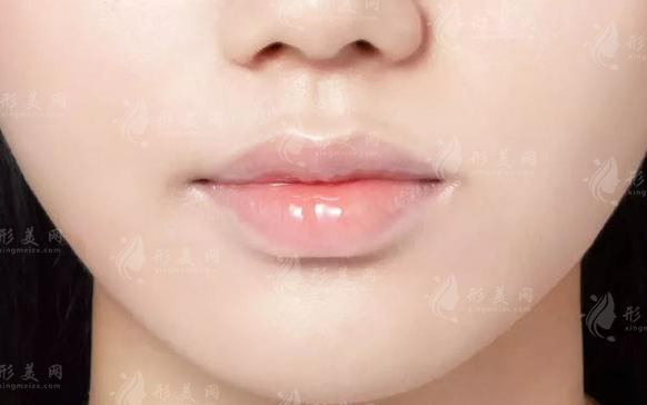 玻尿酸豐唇多久能消腫?