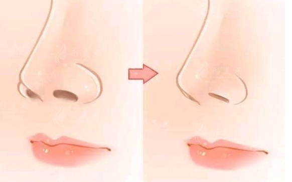 內(nèi)切鼻翼縮小有副作用嗎?