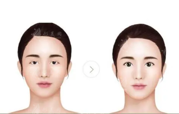 上瞼下垂矯正術的禁忌癥有哪些?