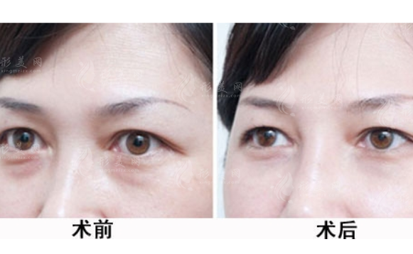 吸脂去眼袋有副作用嗎？整理下吸脂去眼袋的副作用~