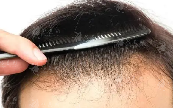 北京八大處整形植發(fā)多少錢？院內(nèi)醫(yī)生介紹、植發(fā)項(xiàng)目、價(jià)格表更新