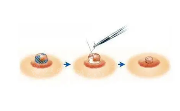 乳頭縮小術(shù)的原理是怎樣的？安全性到底高不高呢？