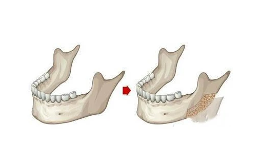 趙延峰醫(yī)生磨骨怎么樣？