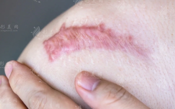 上海第九人民醫(yī)院疤痕修復(fù)價格是多少？實力醫(yī)生名單+相關(guān)價目信息