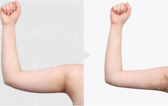 上海九院整形手臂吸脂多少錢？手臂吸脂案例+口碑醫(yī)生+價格表