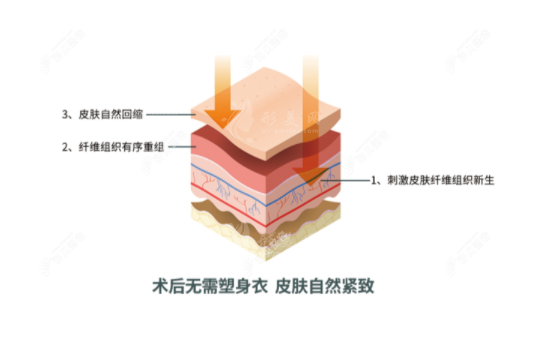 曹孟君治療富貴包怎么樣？土麥森吸脂技術(shù)可從根本解決問題
