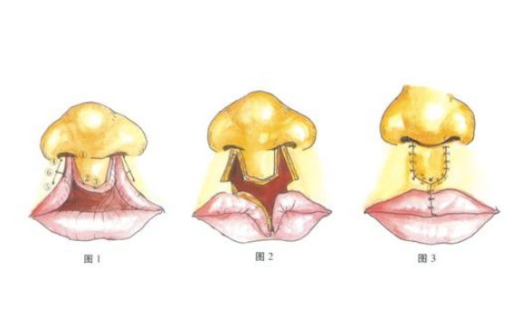 上海九院做兔唇修復(fù)怎么樣？專家信息、項(xiàng)目介紹、價(jià)格表