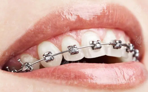 西安西京醫(yī)院牙齒矯正收費(fèi)，牙齒矯正案例分享+價(jià)目表