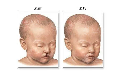 上海第九整形美容醫(yī)院唇腭裂修復(fù)價格