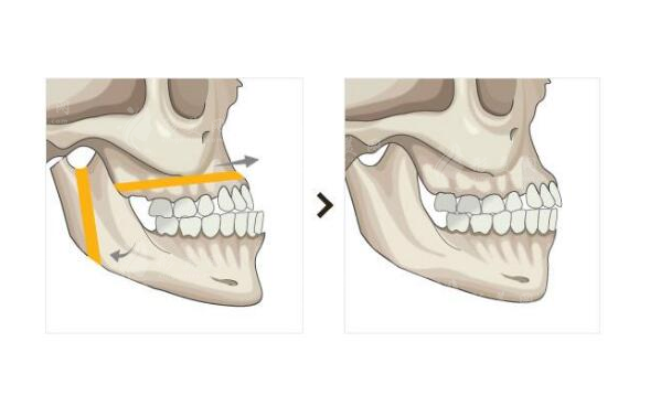上海九院做雙鄂手術(shù)多錢?整友在上海九院做雙鄂花了6.4w元