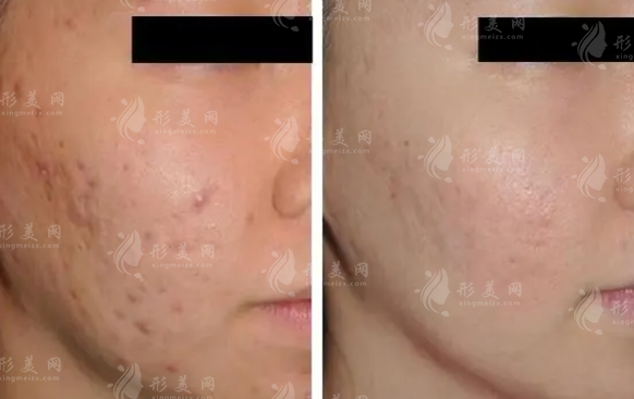 激光祛斑祛痘有哪些優(yōu)勢(shì)？