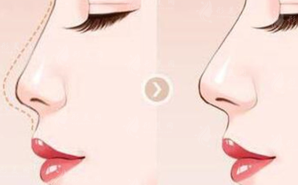 膨體隆鼻容易感染嗎?怎樣能夠有避免感染呢?