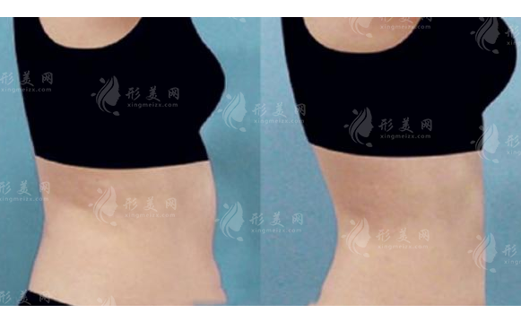 腰腹環(huán)吸有什么副作用?恢復(fù)時(shí)間?