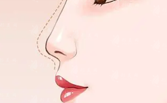 西京醫(yī)院做假體隆鼻多少錢？上榜醫(yī)生技術(shù)不錯、案例、價目表