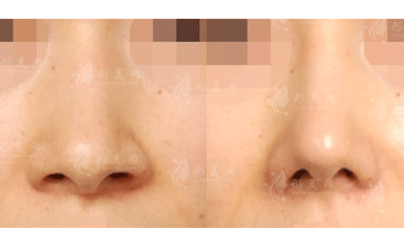 鼻翼過寬整形注意事項(xiàng)有哪些?