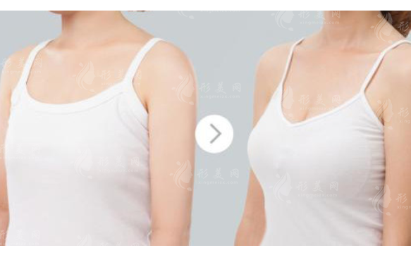 上海九院豐胸手術(shù)一般多少錢？口碑專家信息、隆胸術(shù)價(jià)目表