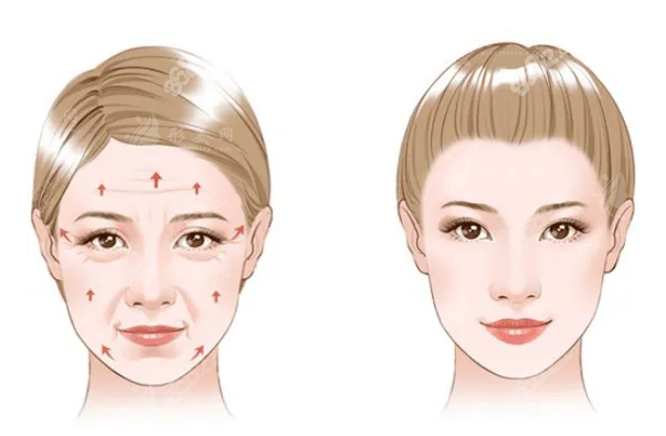 南京施爾美整形醫(yī)院拉皮價目表，大拉皮+小拉皮收費詳情