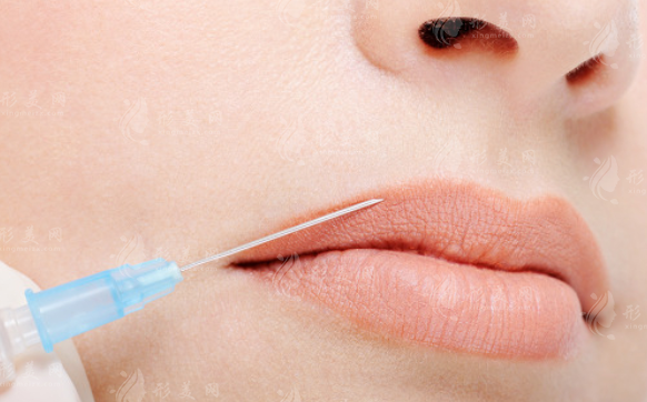 注射膠原蛋白豐唇有哪些優(yōu)勢?效果好不好?