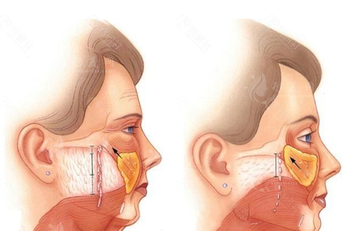 上海第九人民醫(yī)院拉皮：30000元起，告別皺紋困擾！