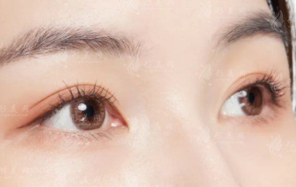 無(wú)痕雙眼皮怎么做出來(lái)的？維持時(shí)間,多久恢復(fù)和價(jià)格參考