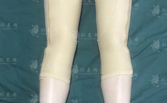 大腿抽脂有什么風險和后遺癥？