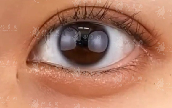 臥蠶打膠原蛋白還是玻尿酸?