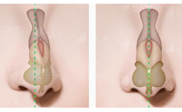 鼻中隔偏曲手術(shù)風(fēng)險大嗎？