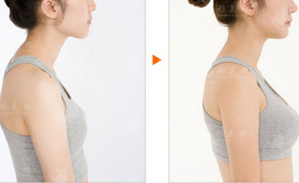 北京八大處整形脂肪豐胸怎么樣？實力專家名單、附全新價格表