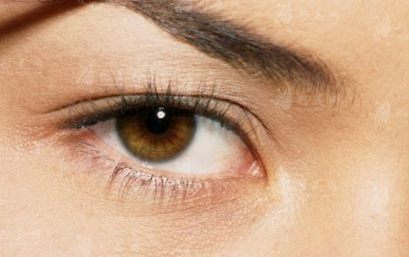 自體脂肪填充下眼瞼凹陷可以維持多久? 自體脂肪填充下眼瞼凹陷可以維持多久?