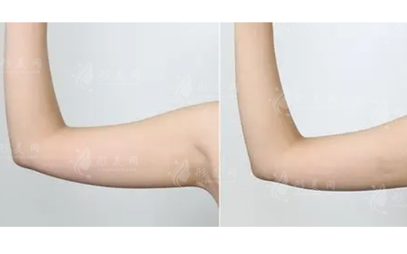 手臂抽脂恢復(fù)過程：消腫與持久效果的探討