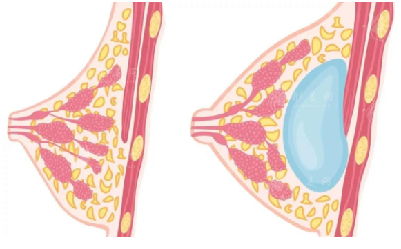 南京蘇王整形豐胸怎么樣？醫(yī)生詳細(xì)介紹+2024價(jià)格表更新