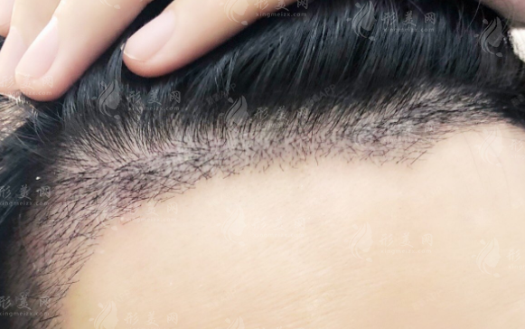 上海九院植發(fā)價格是多少？技術(shù)優(yōu)勢，植發(fā)醫(yī)生、價格表分享