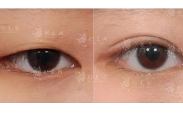 疤痕體質(zhì)能割雙眼皮嗎？割了雙眼皮怎么消腫快？