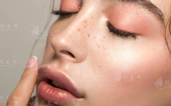 激光祛斑大概多少錢？和哪些因素有關？