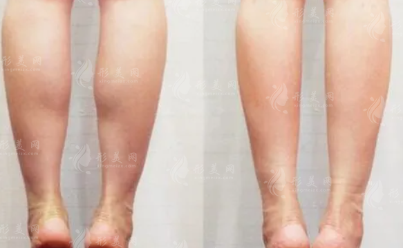怎么快速瘦小腿？吸脂后怎么護(hù)理腿部？