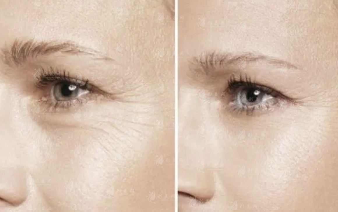 注射除皺要多少錢?注射除皺之后的護(hù)理方法